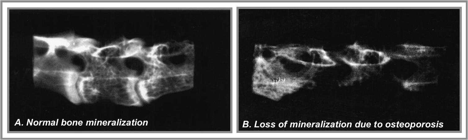 Radiograph (X-ray) images showing vertebrae with and without osteoporosis. Source: Whitehead and Fleming