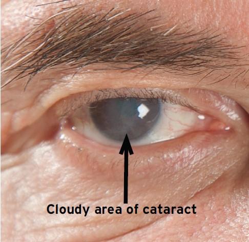 A view of a human eye, where a cloudy area of a cataract is clearly visible.