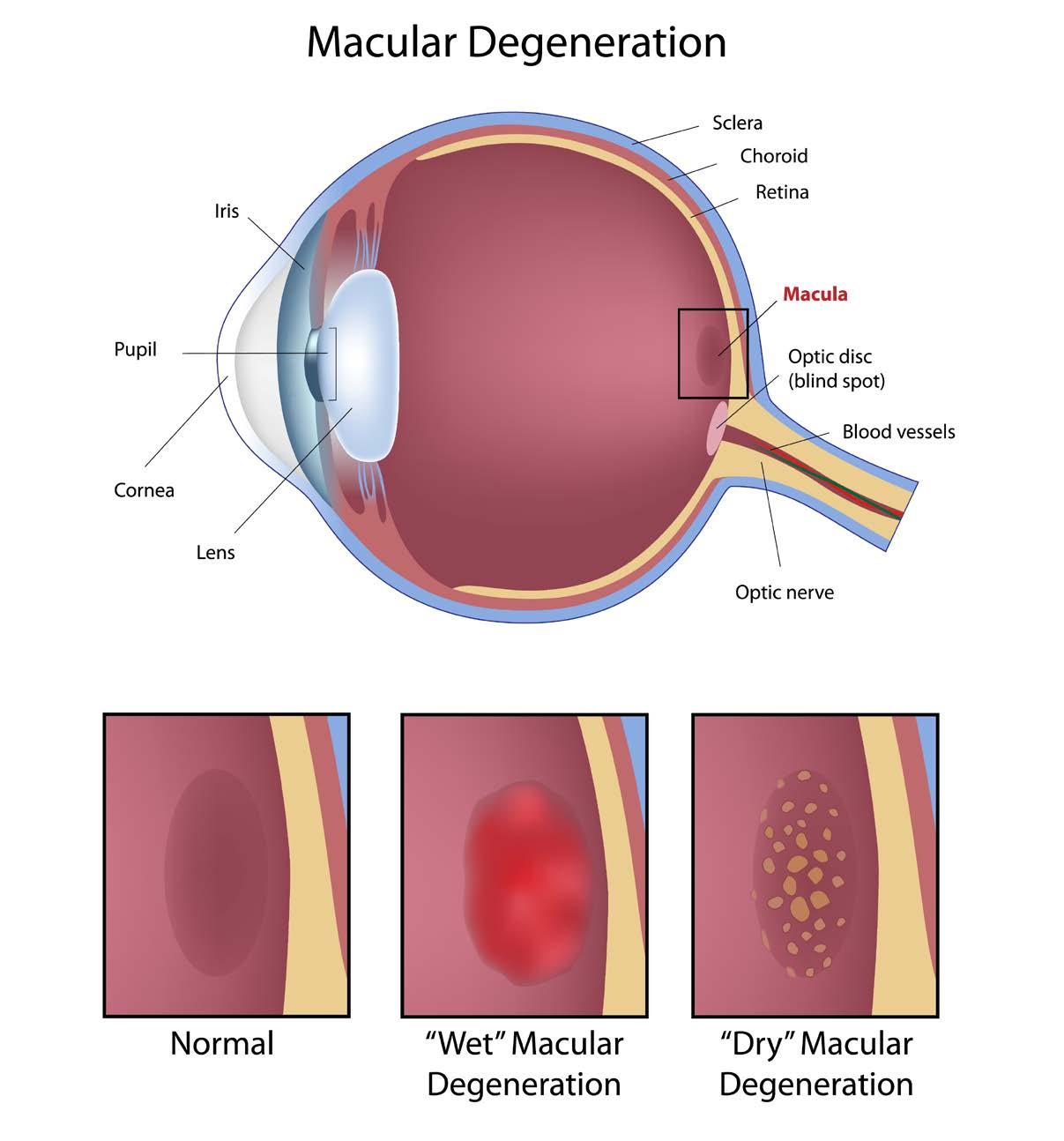 A diagram that portrays a comparison between the wet and dry forms of macular degeneration as seen through the human eye.
