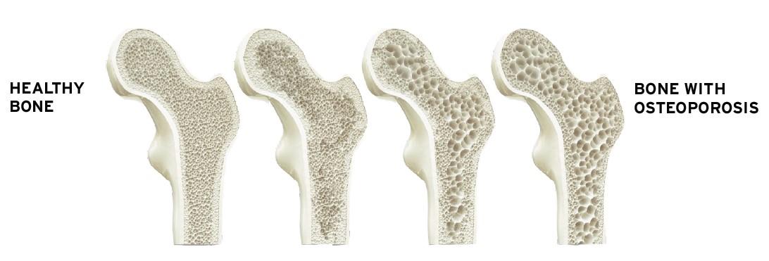 Four images showing the progression of osteoporosis in a bone from a healthy state to a more advanced stage.
